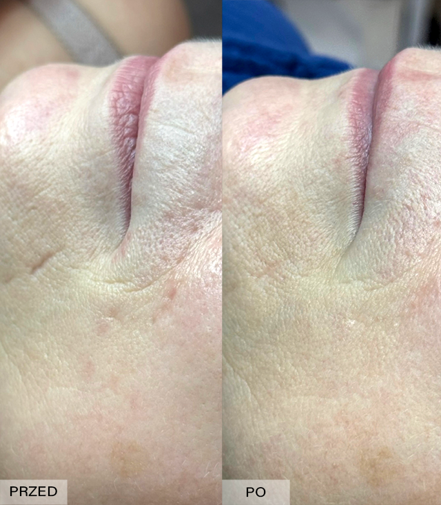 usuwanie blizn efekty